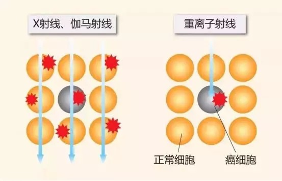 質子重離子技術醫(yī)療險可以報銷嗎？