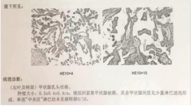 別慌，甲狀腺疾病還可以這樣投保！